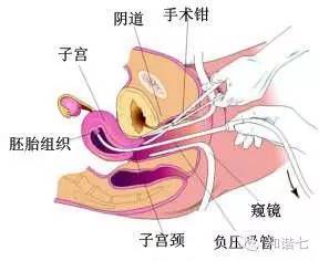你知人流无痛,可知其不育风险?-负压吸引术
