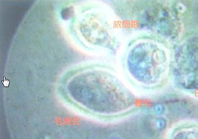 滴虫性阴道炎的治疗方法