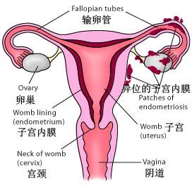 得了子宫内膜异位症有哪些危害