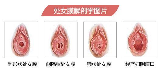 呼和浩特处女膜修复一下需要多少钱