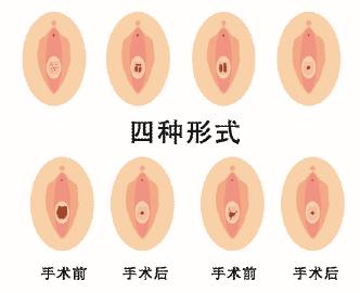 呼市处女膜修复术过程是怎样的?