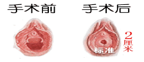 处女膜问题,知多少!