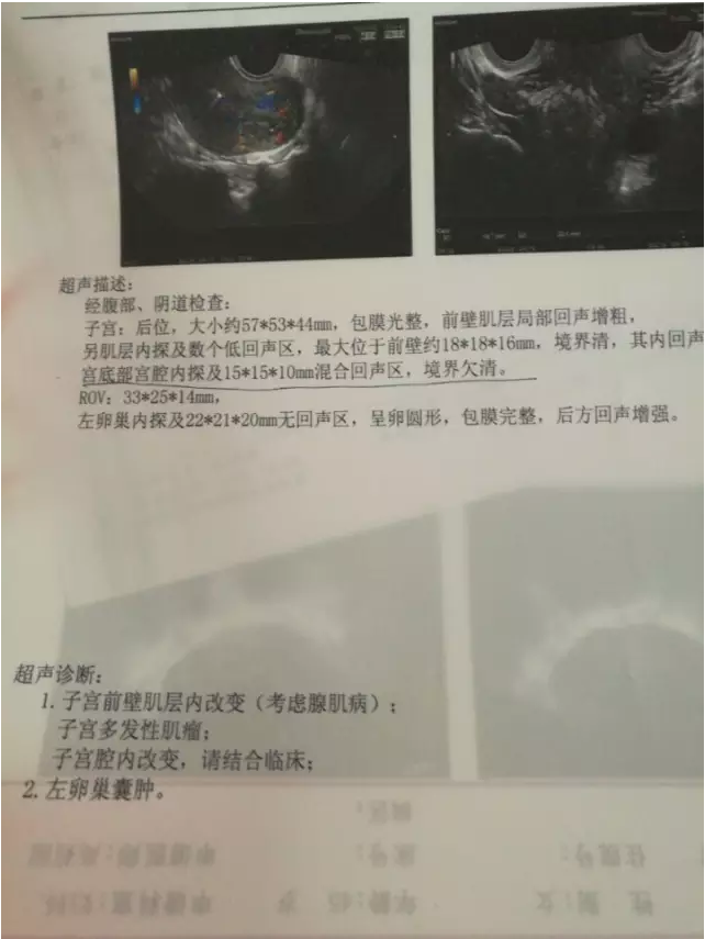 拥有20多年临床经验的妇科专家李丽检查后初步诊断刘丽患有子宫腺肌瘤。与患者沟通后决定两天后用奥洛克超导多弹头系统治疗。