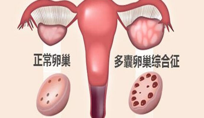 稀发排卵或无排卵