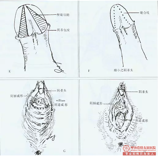 阴蒂肥大手术处理