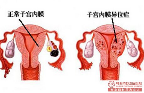 呼和浩特宫颈囊肿手术治疗费用