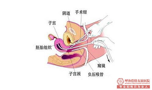 【问答】人流好还是药流好?