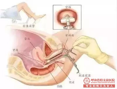 呼市妇科体检哪里好？妇科体检项目，你该怎么选？ 