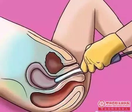 呼市妇科体检哪里好？妇科体检项目，你该怎么选？ 