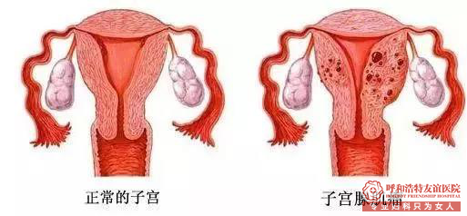 呼市妇科医院医生好吗?幸遇丛医生 如获新生